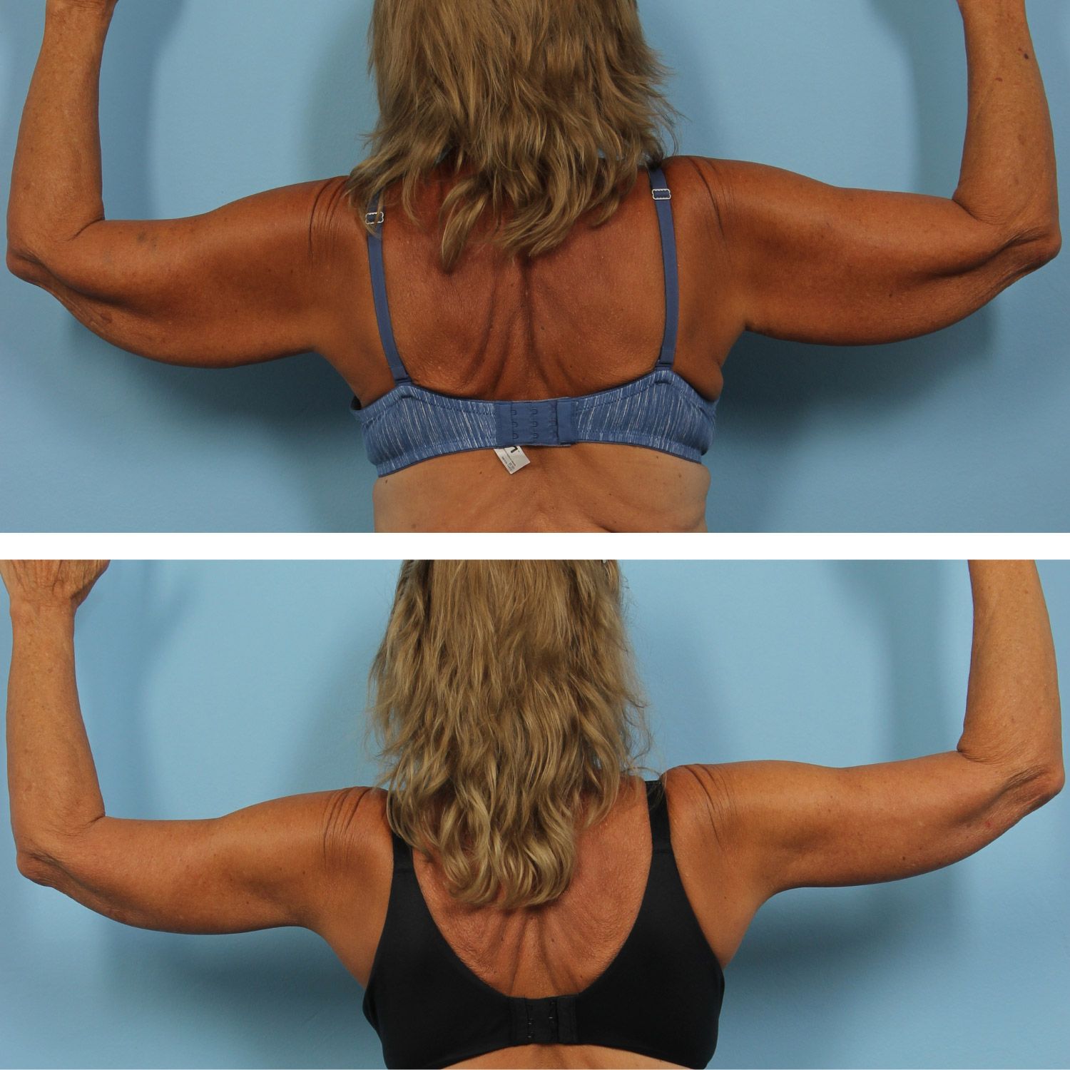 Arm Lift Image 02b