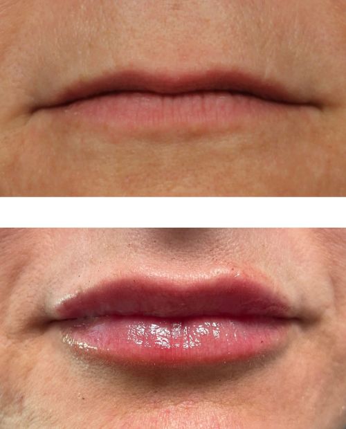 Restylane Visit Image