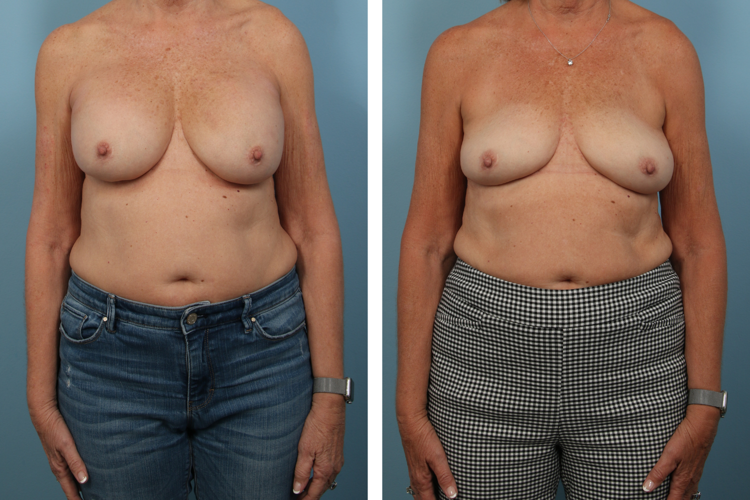 Implant Image 07a