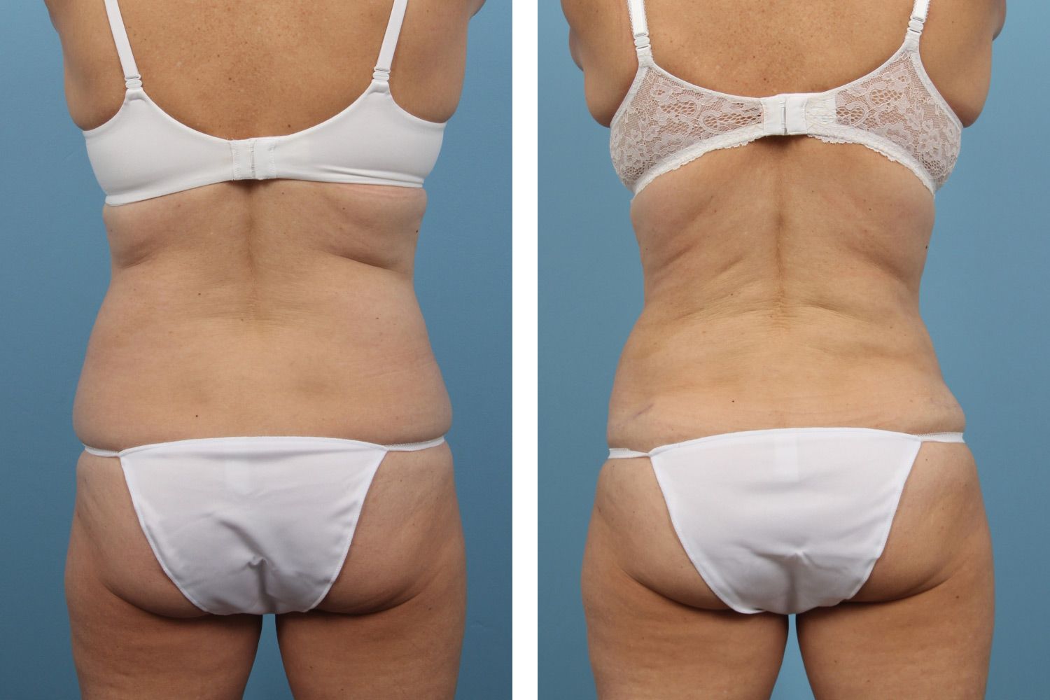 Liposuction Image 03