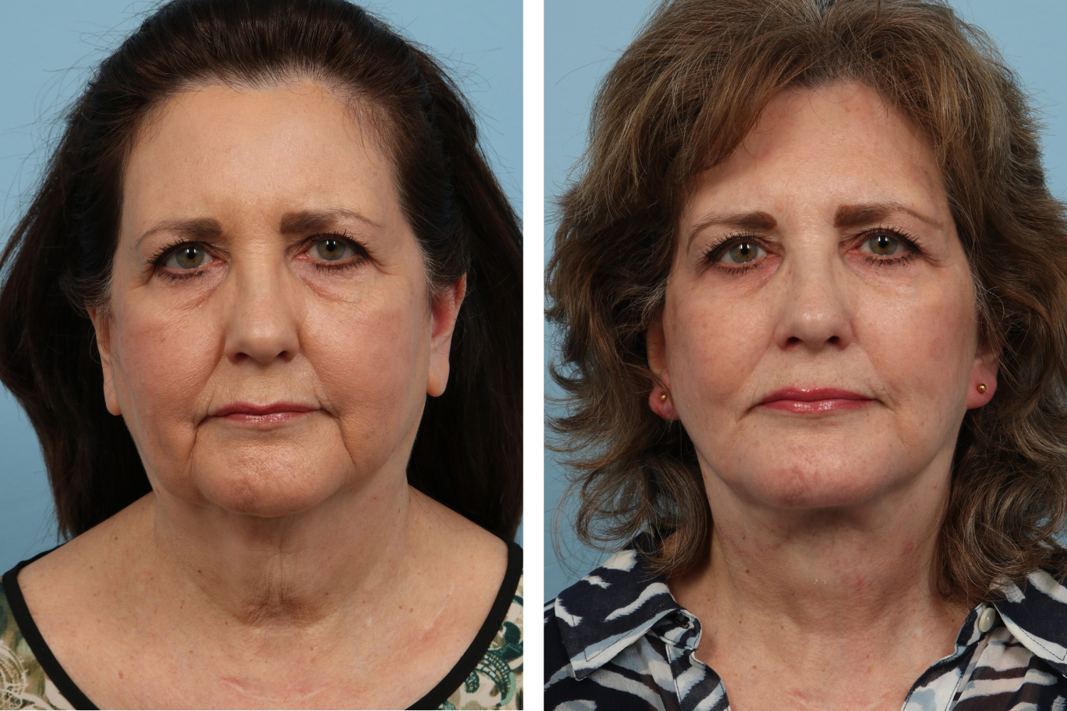 Face Lift Image 08a
