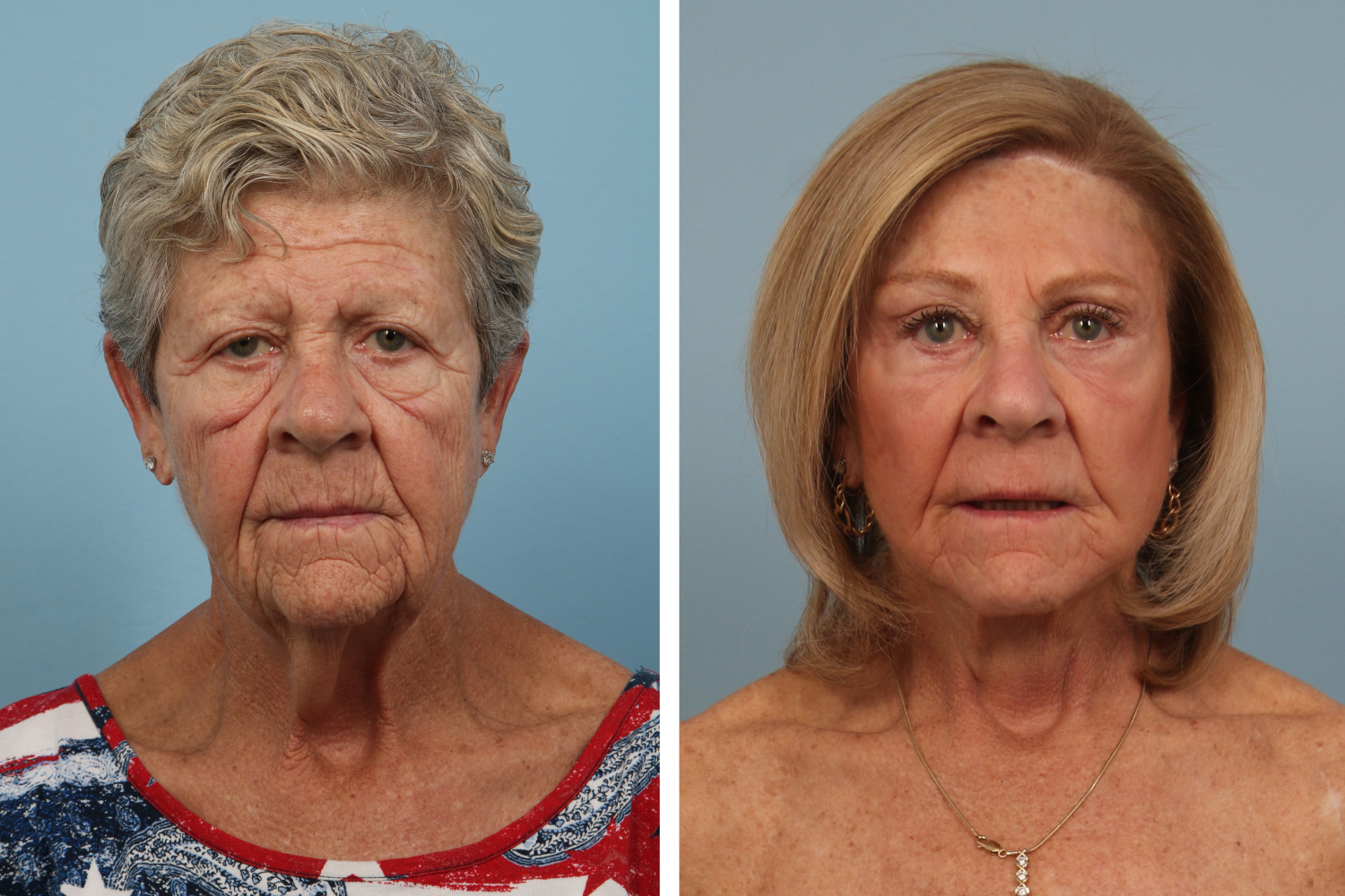 Face Lift Image 27