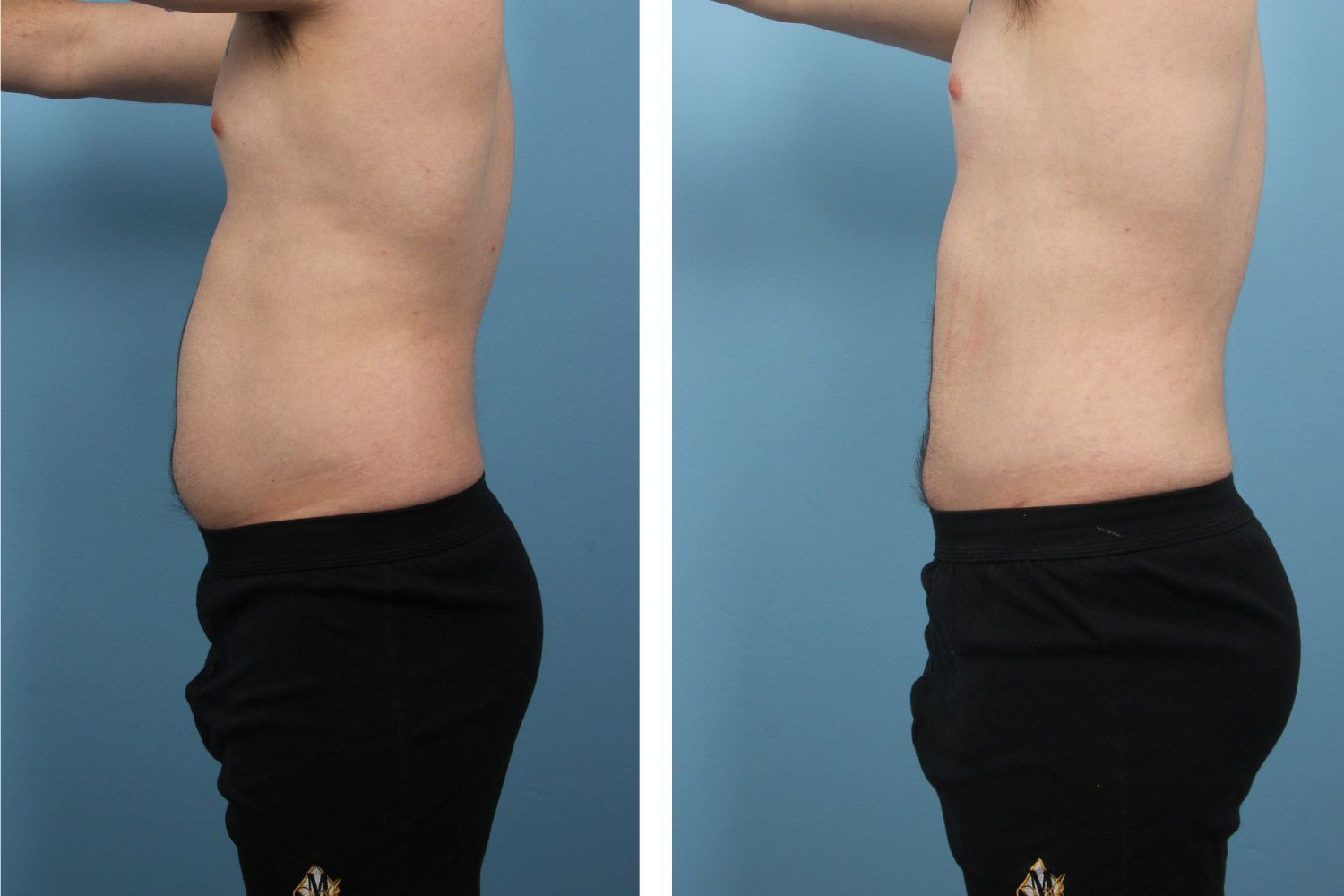 Liposuction Image 02b