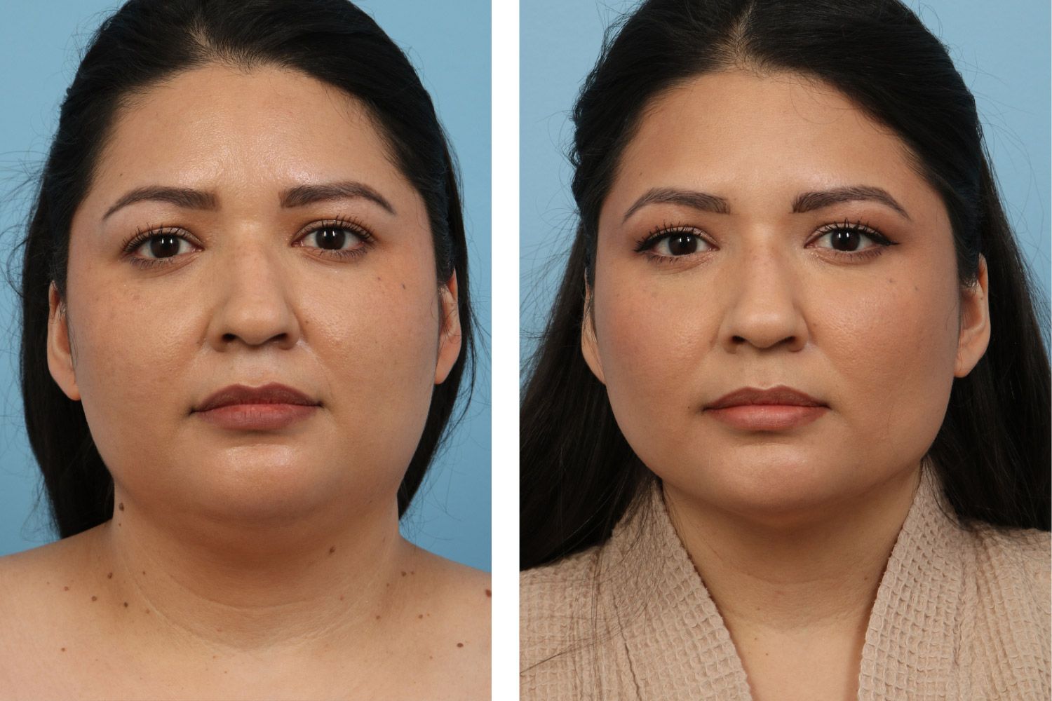 Liposuction Image 01