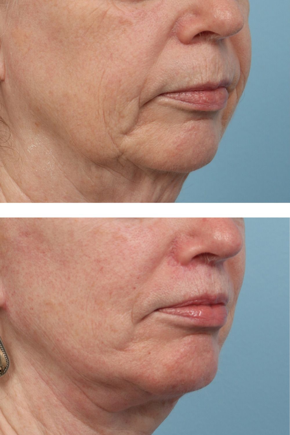 Lip Lift Image 01b