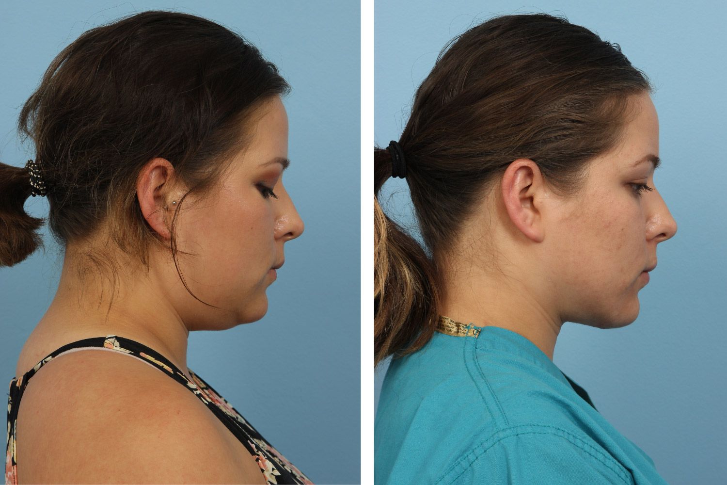 Neck Lift Image 02b