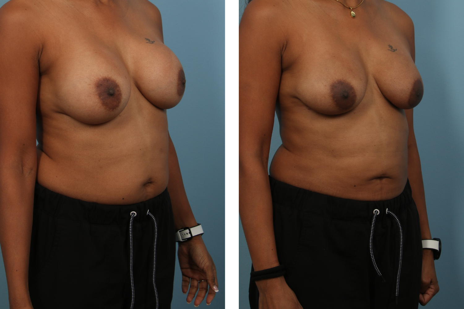 Implant Image 06b