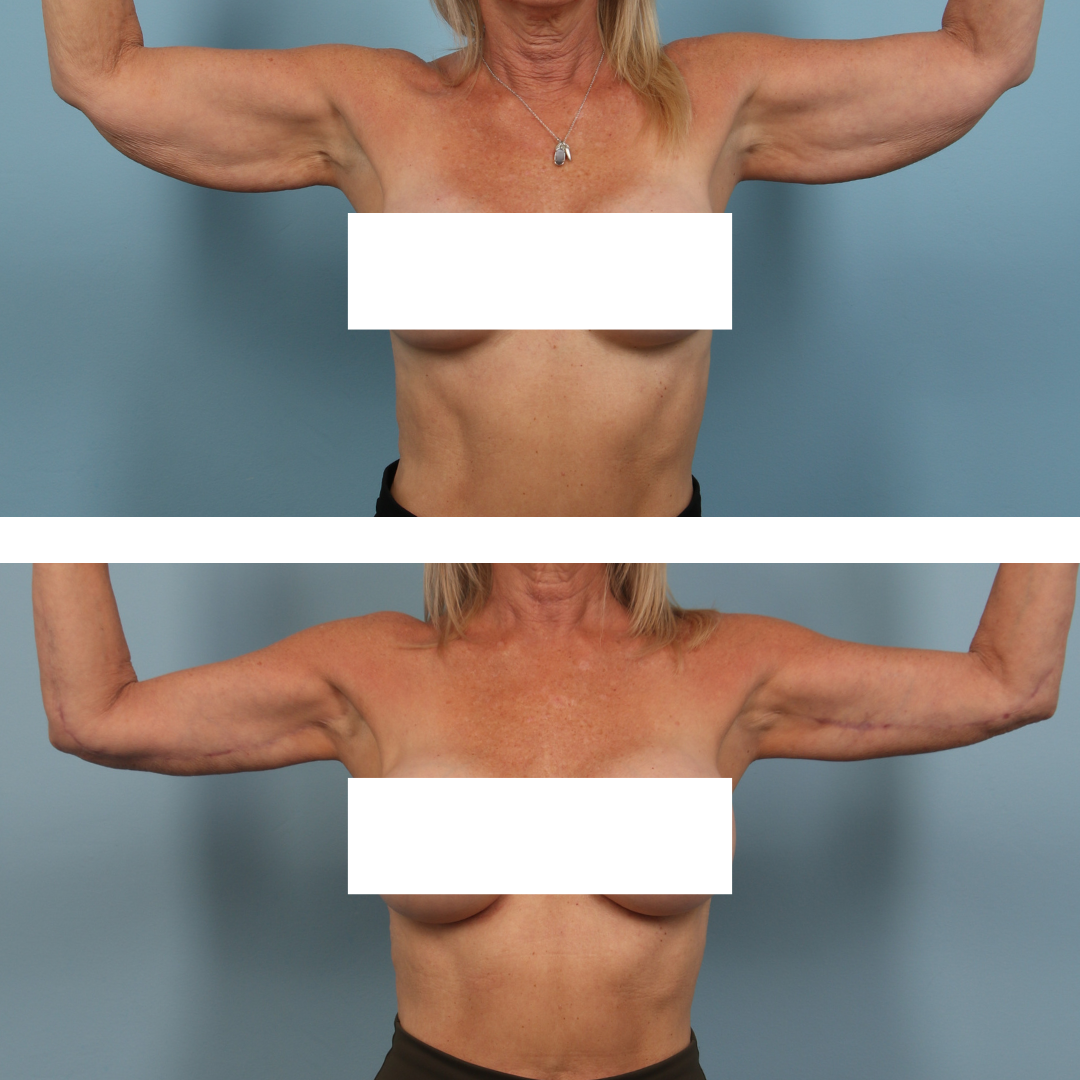 Arm Lift Image 04a