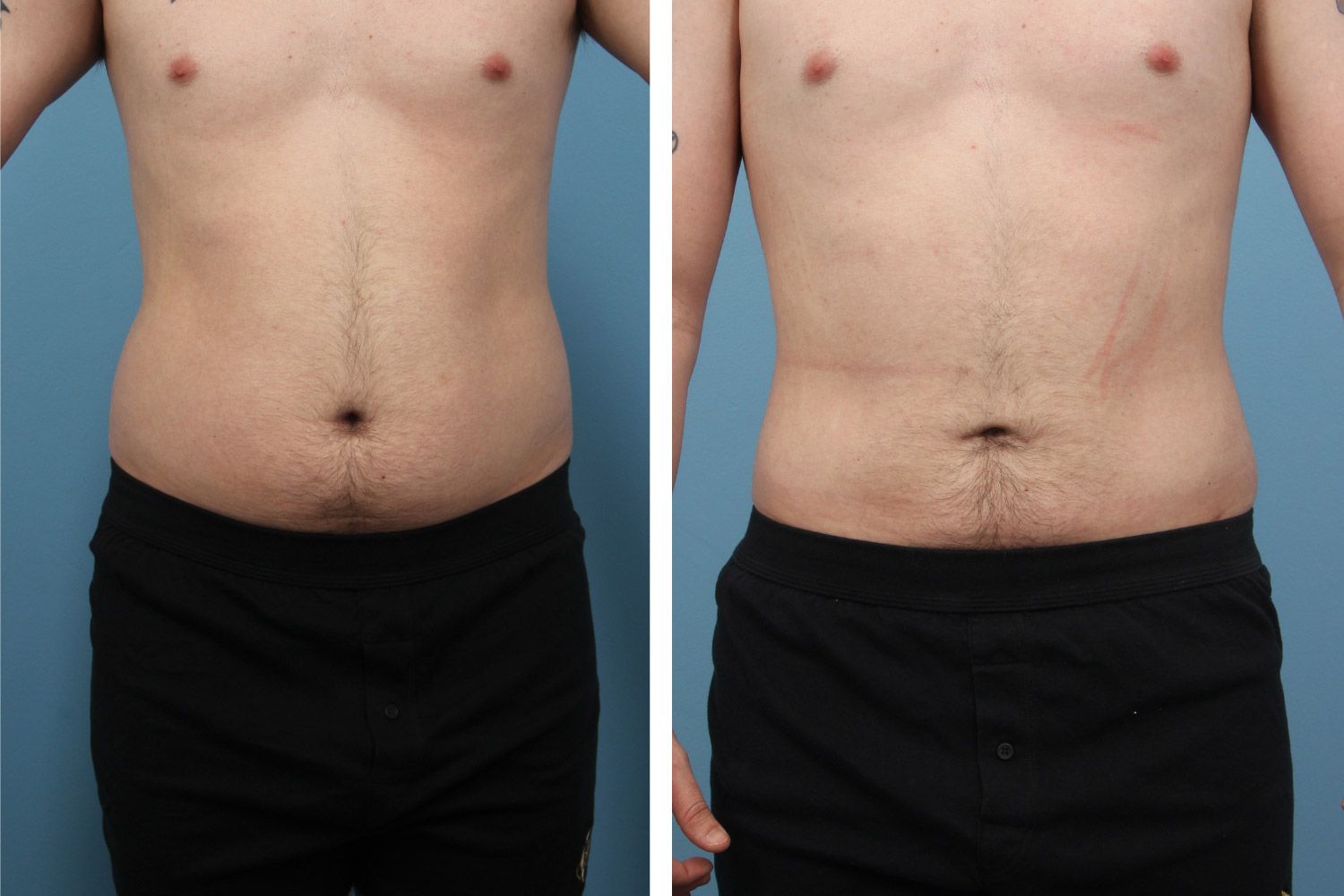 Liposuction Image 02