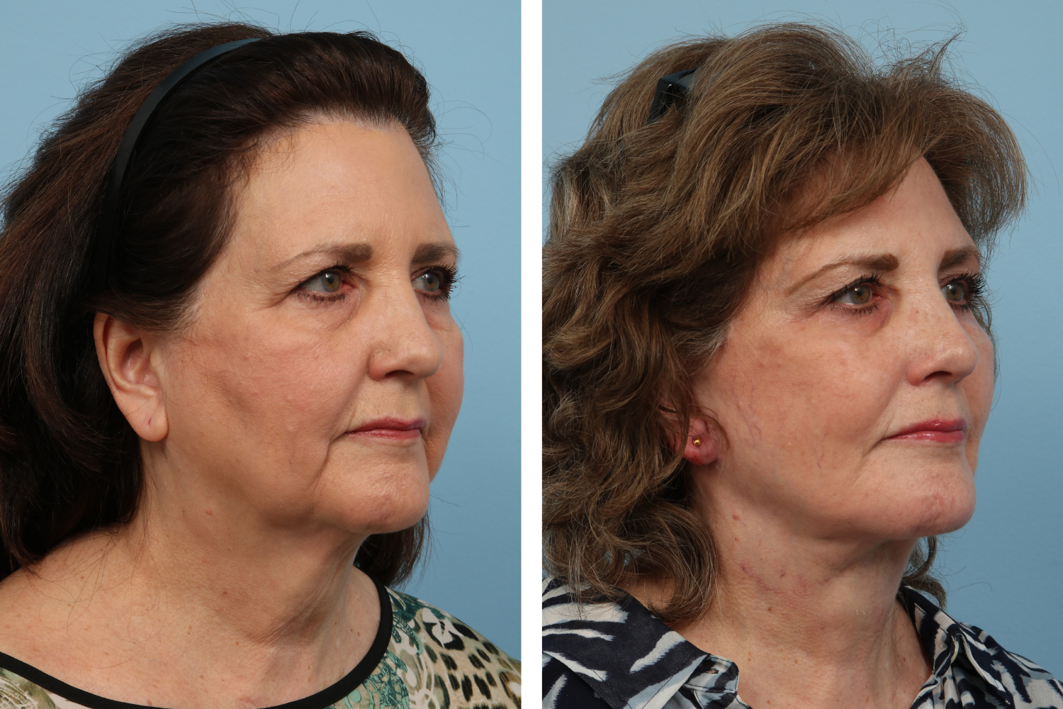 Face Lift Image 08b