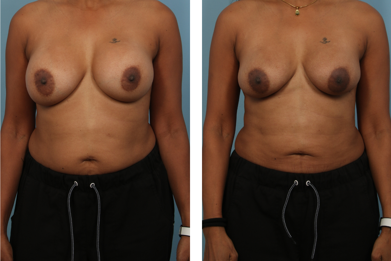 Implant Image 06a