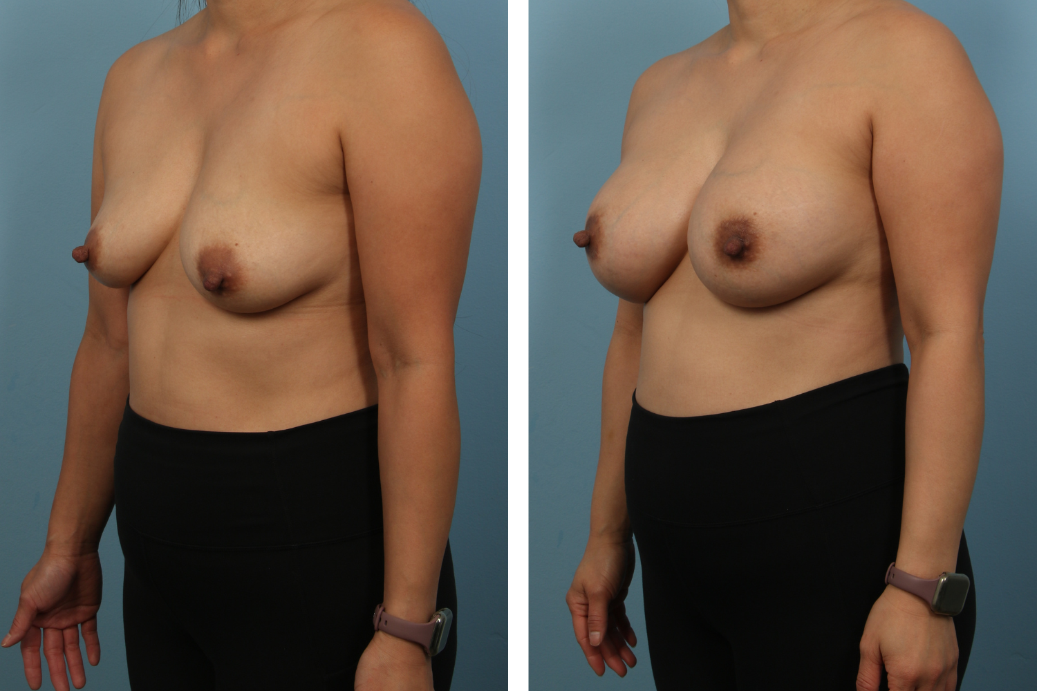Augmentation Image 08b