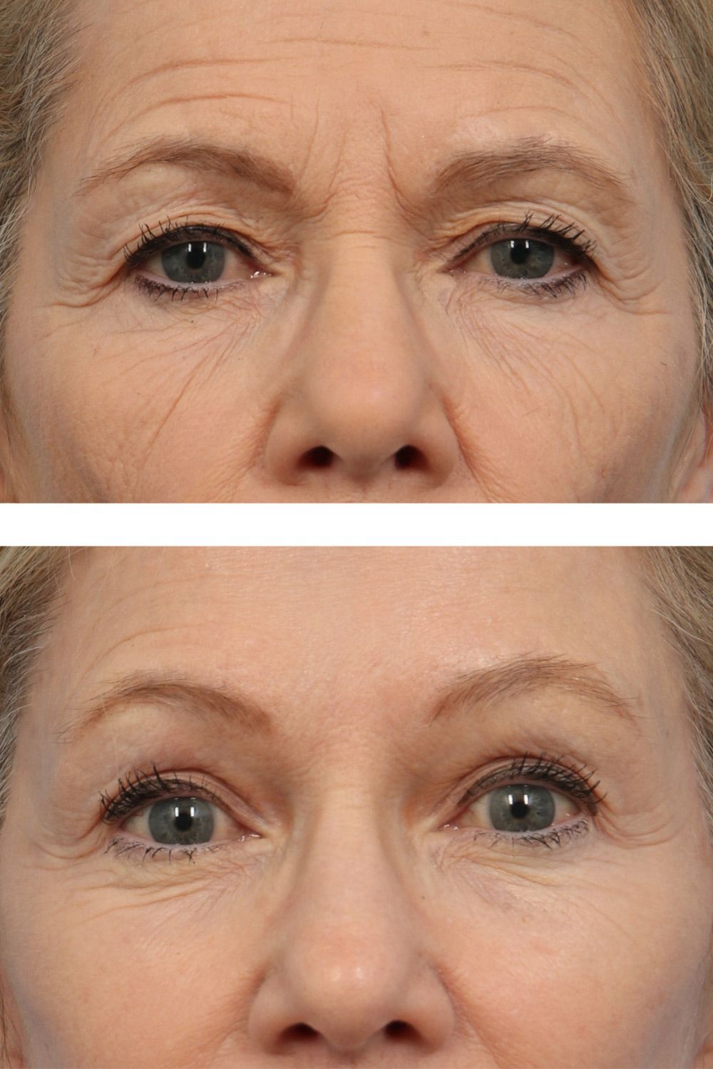 Eye Lift Image 04