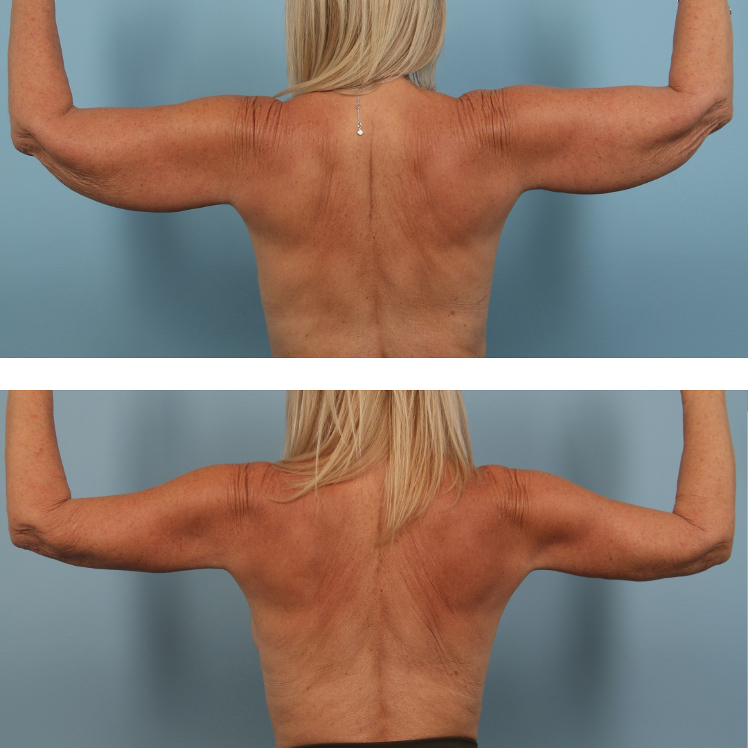 Arm Lift Image 04b