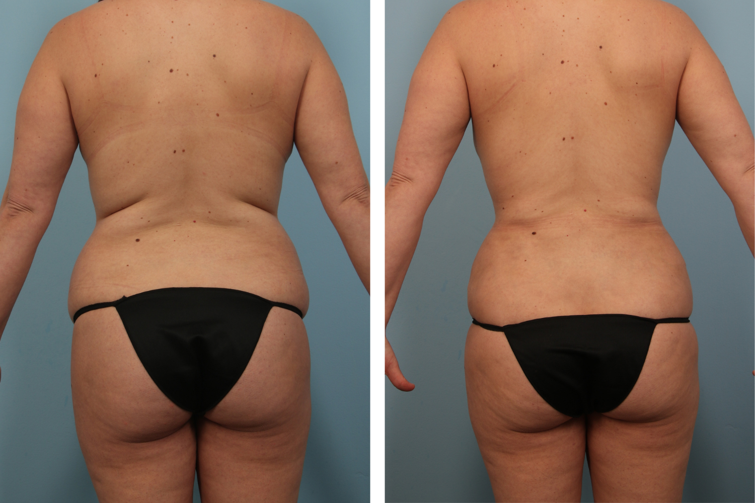 Liposuction Image 06