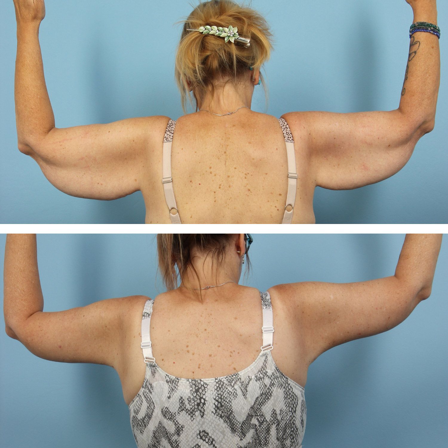 Arm Lift Image 01b