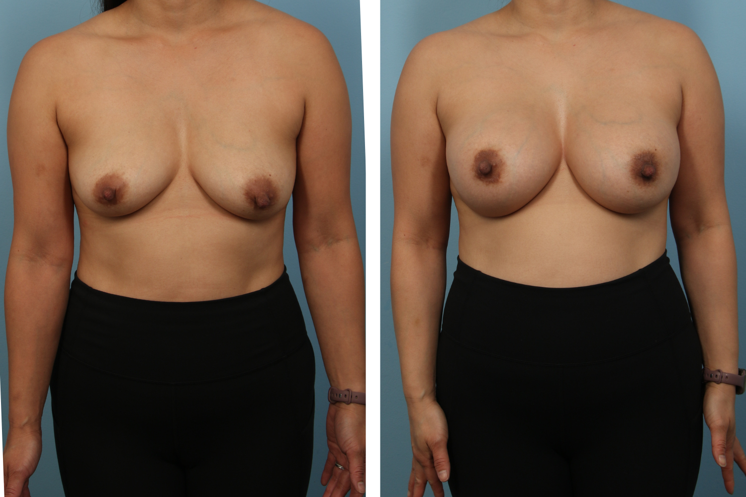 Augmentation Image 08a