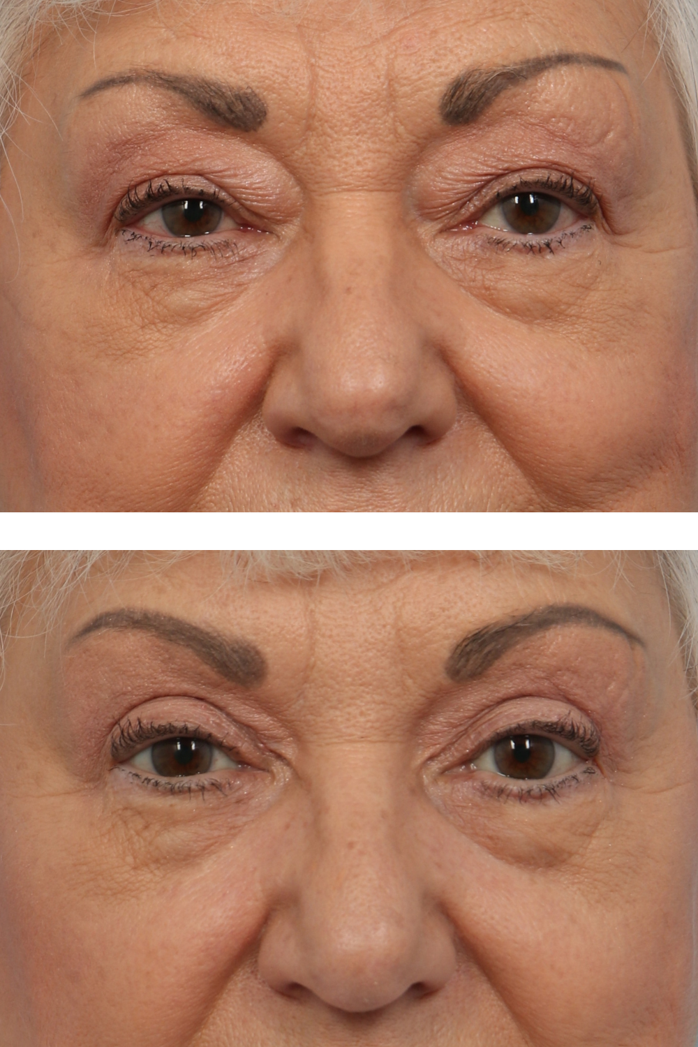 Eye Lift Image 20