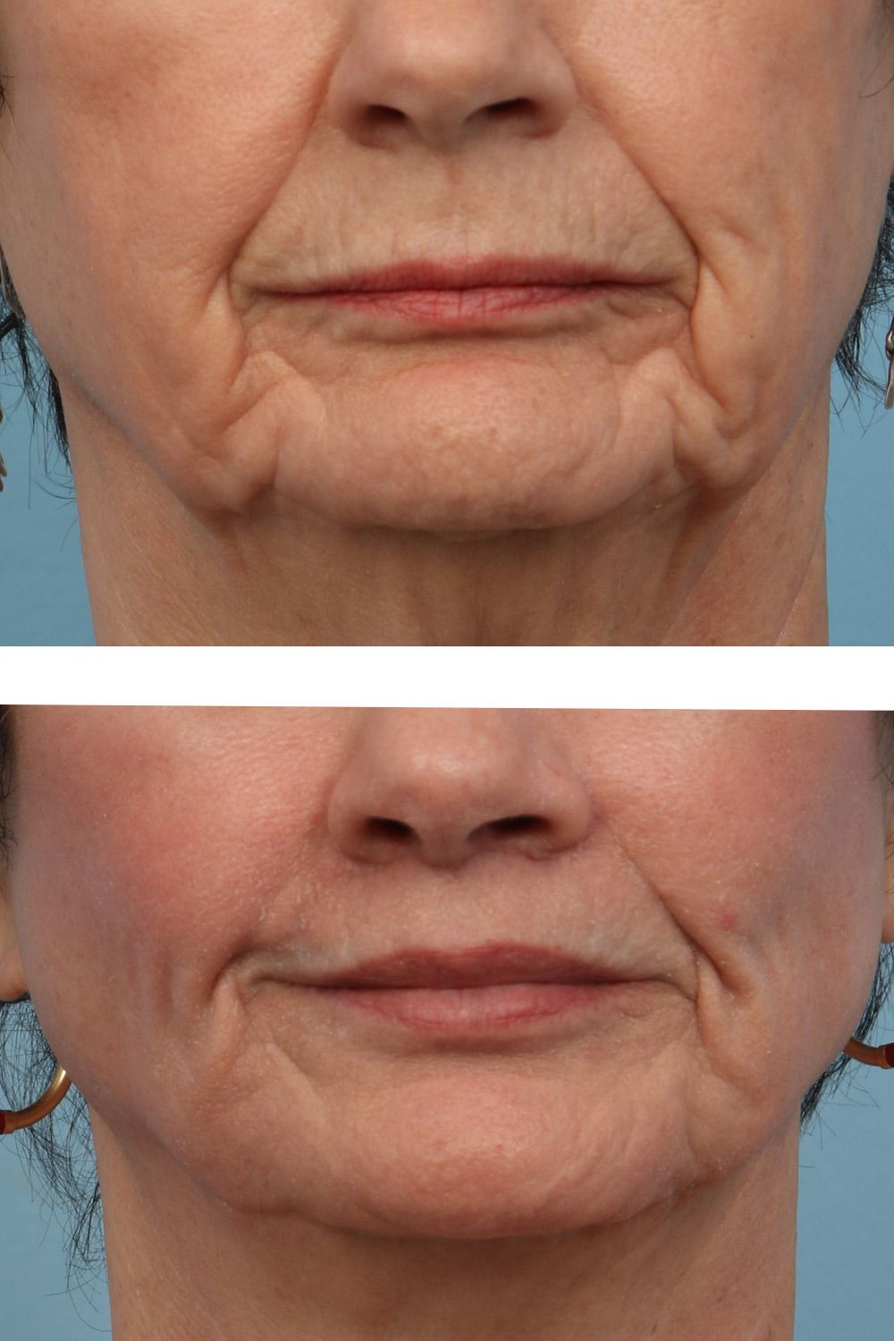 Lip Lift Image 03