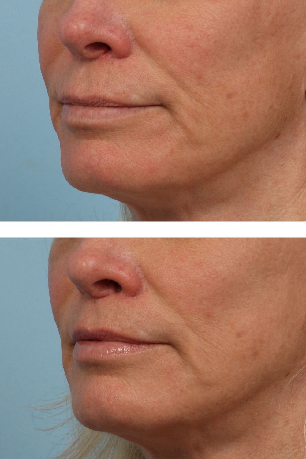 Lip Lift Image 02b