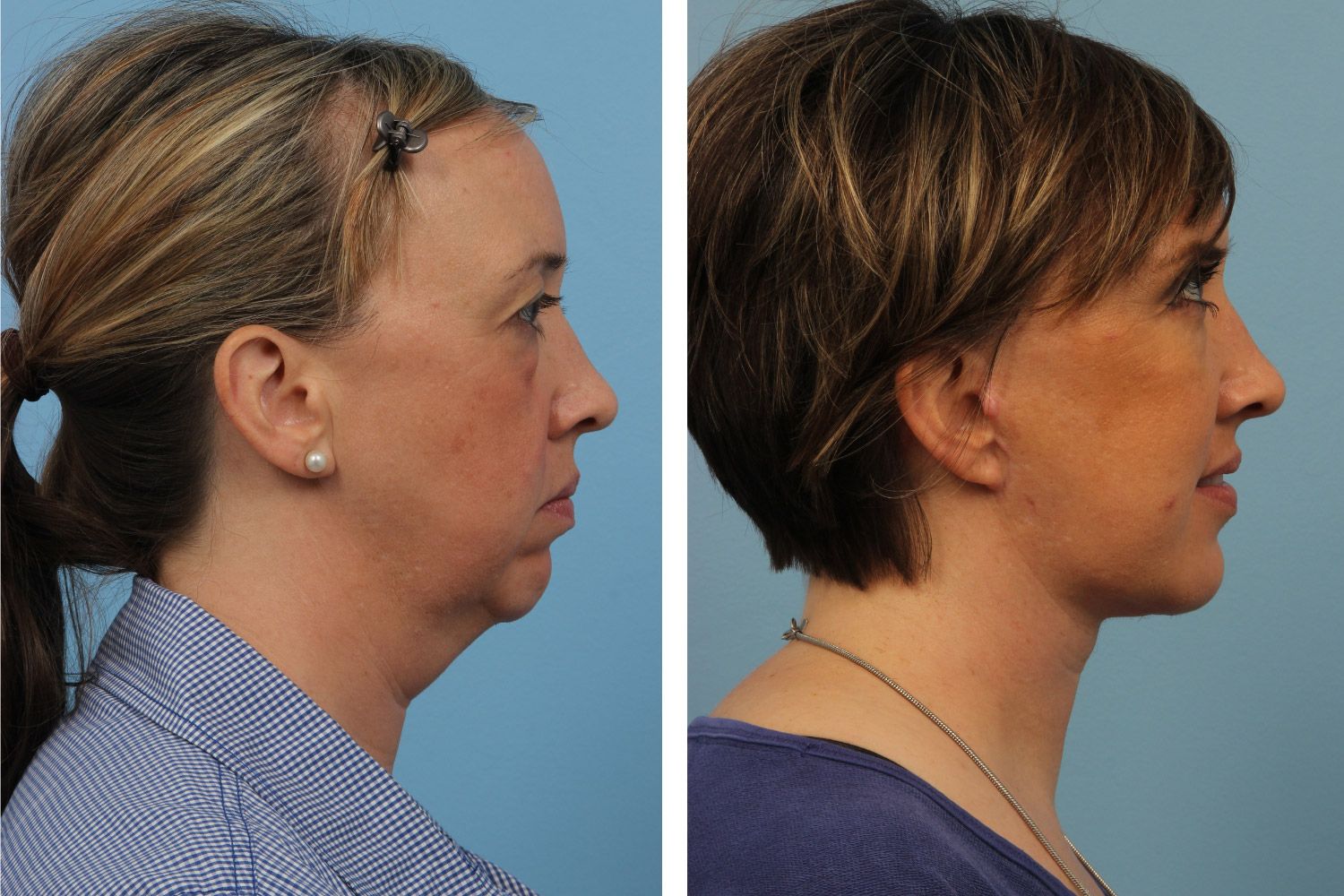 Neck Lift Image 01b