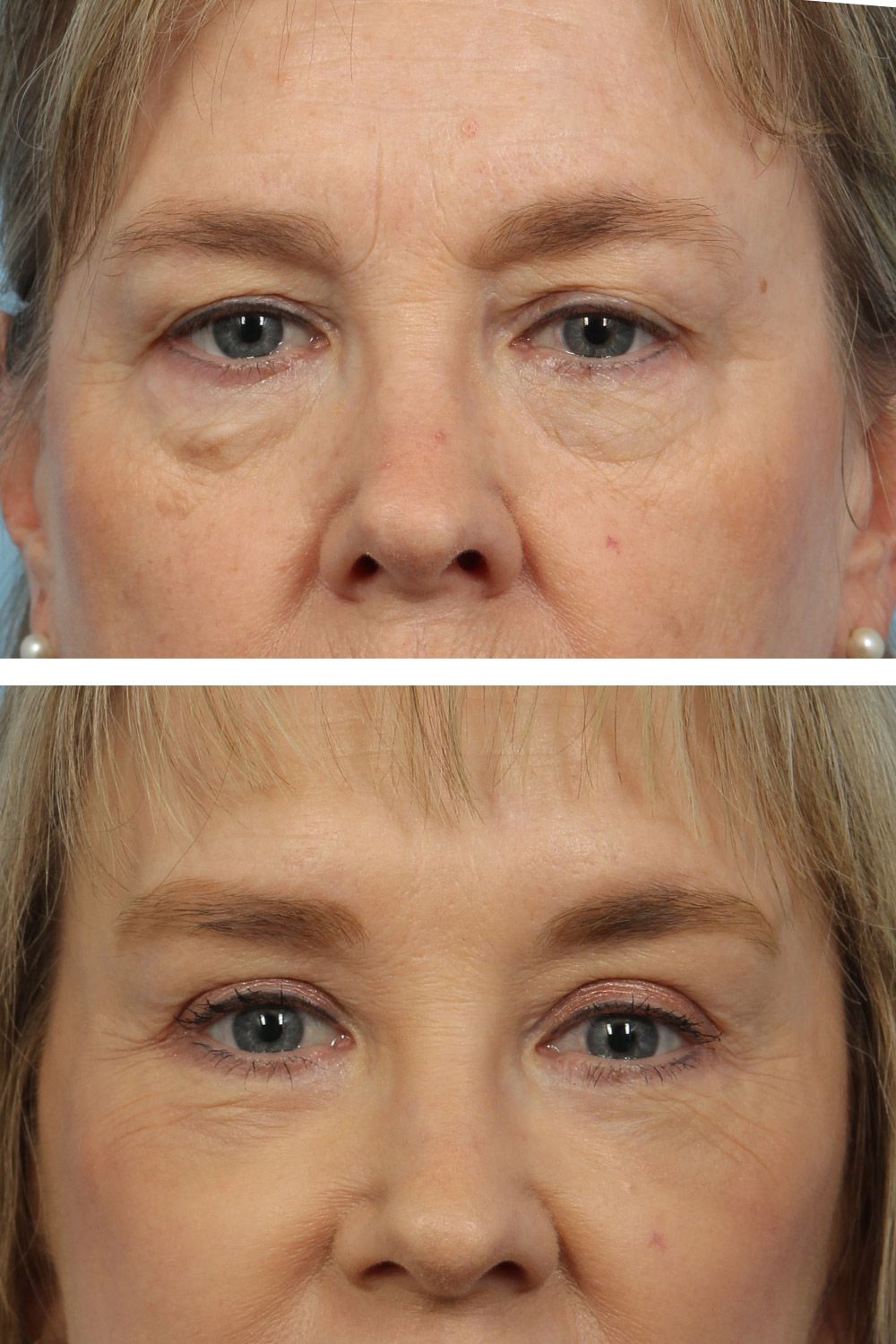 Eye Lift Image 01