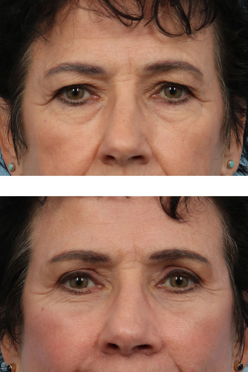 Eye Lift Image 04