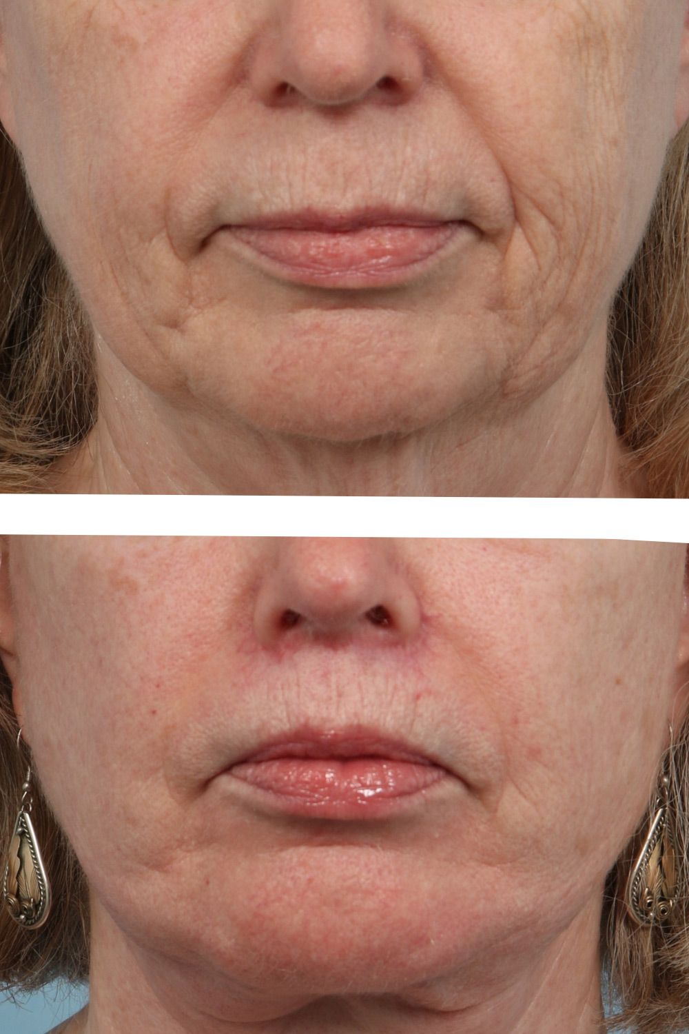 Lip Lift Image 01