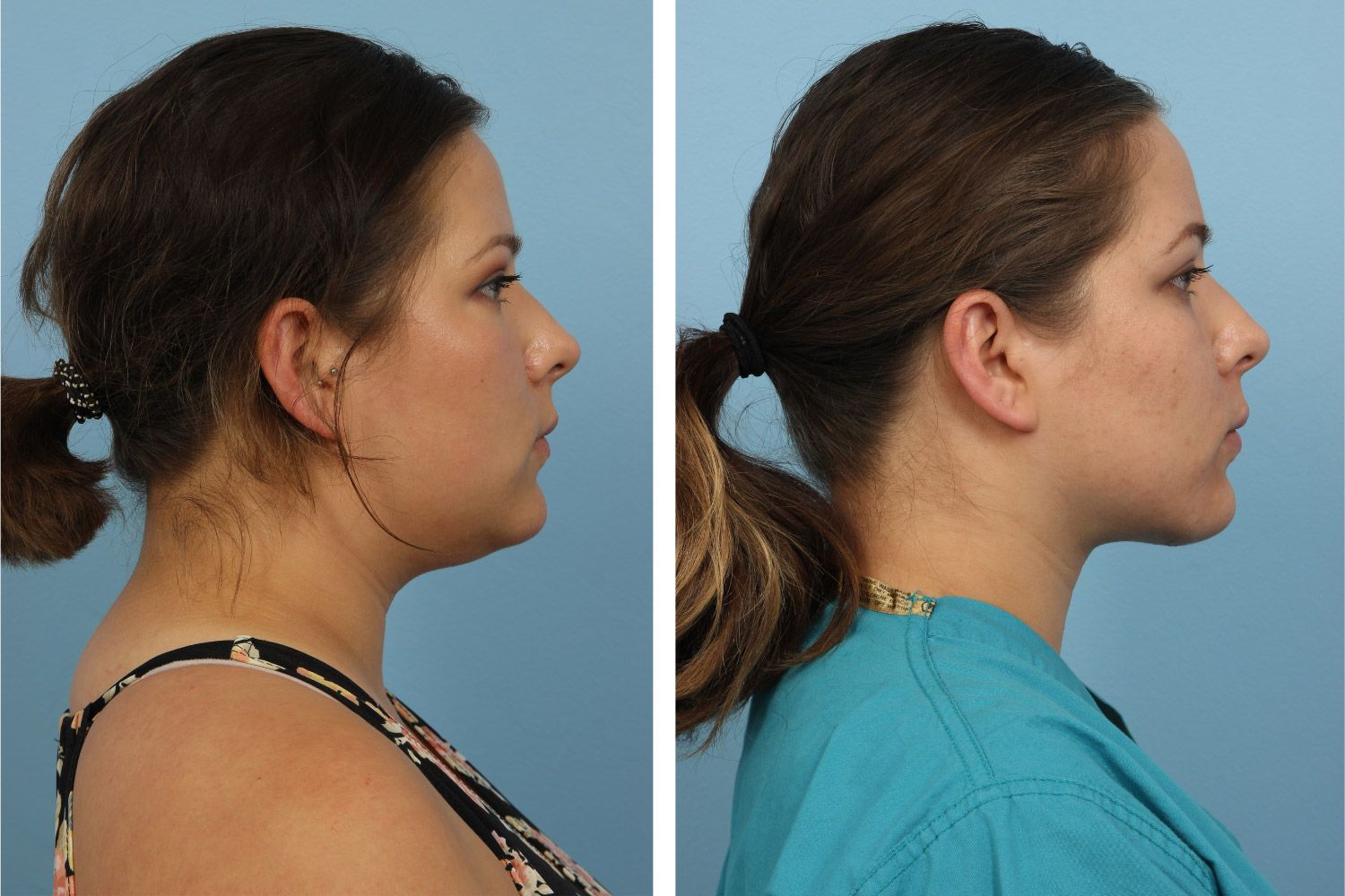 Neck Lift Image 02