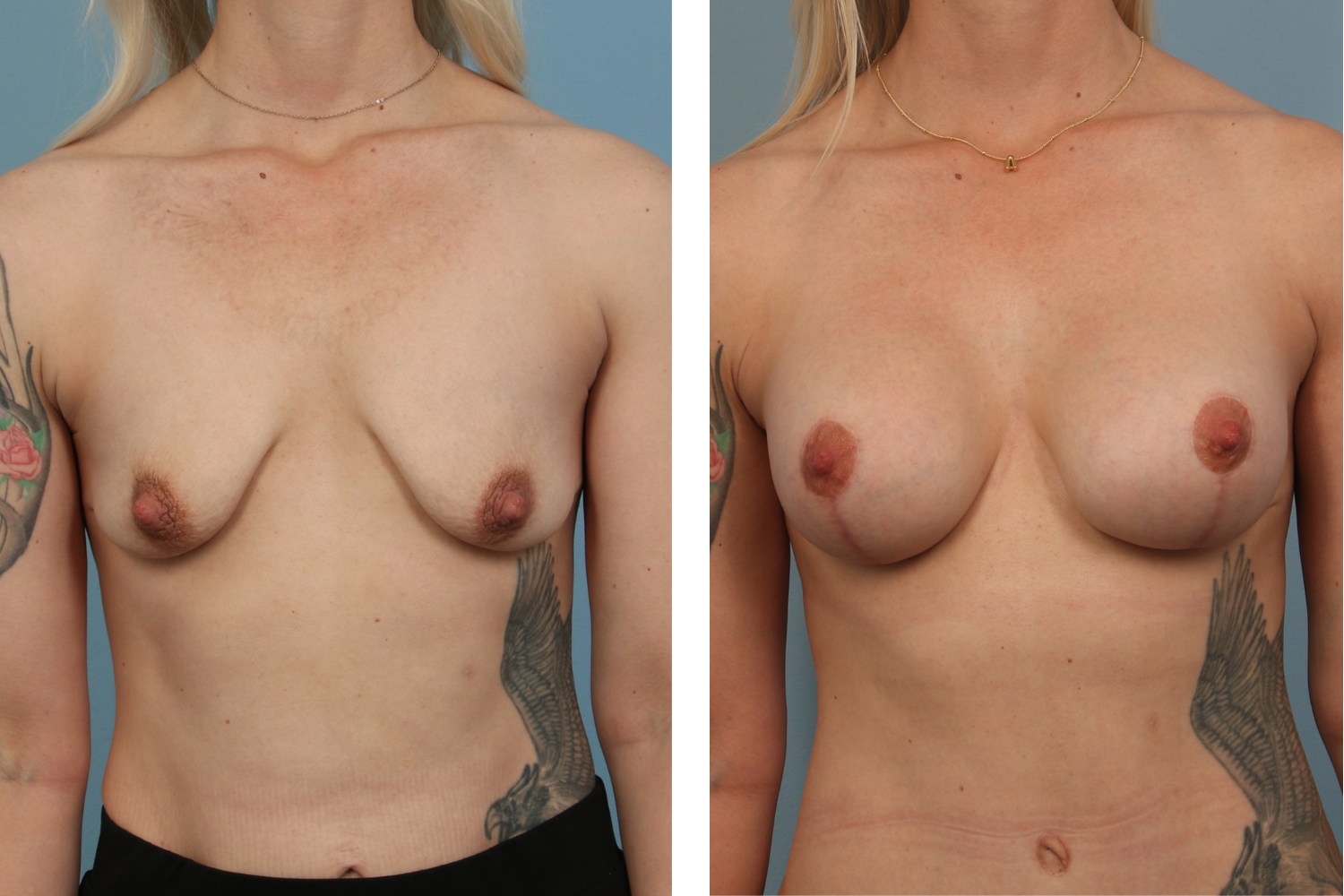 Augmentation Image 07a