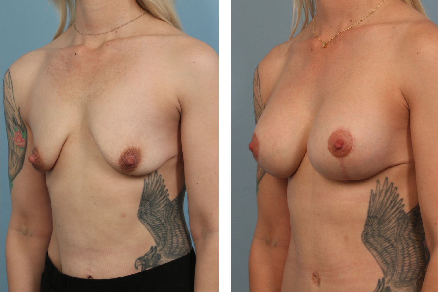 Augmentation Image 07b