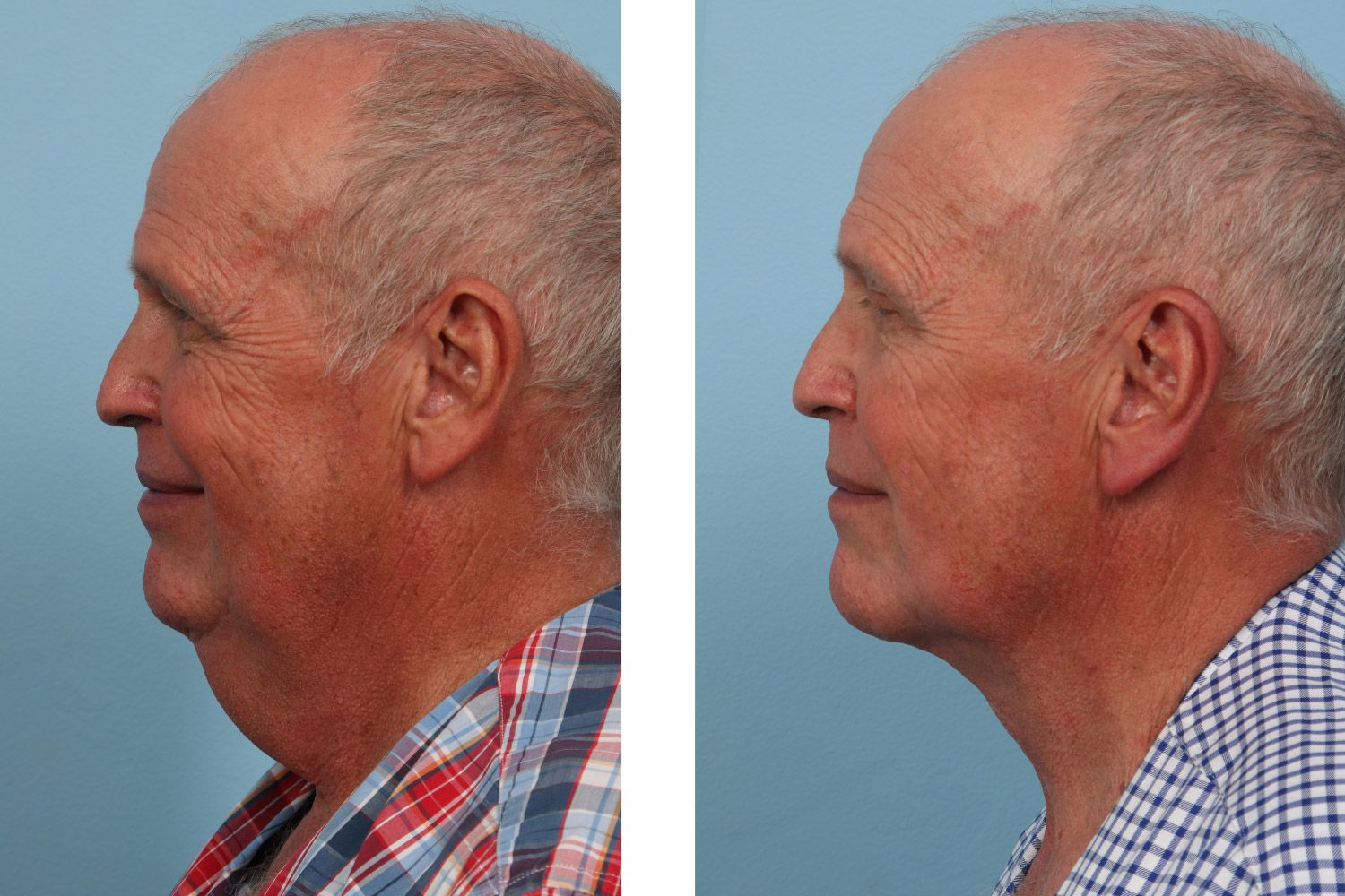 Neck Lift Image 04b