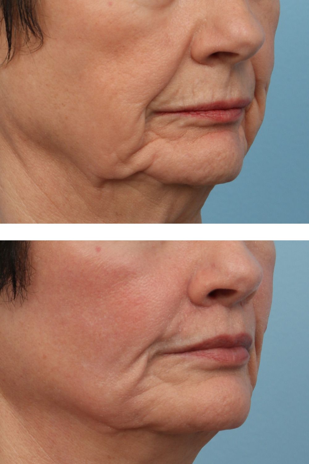 Lip Lift Image 03b