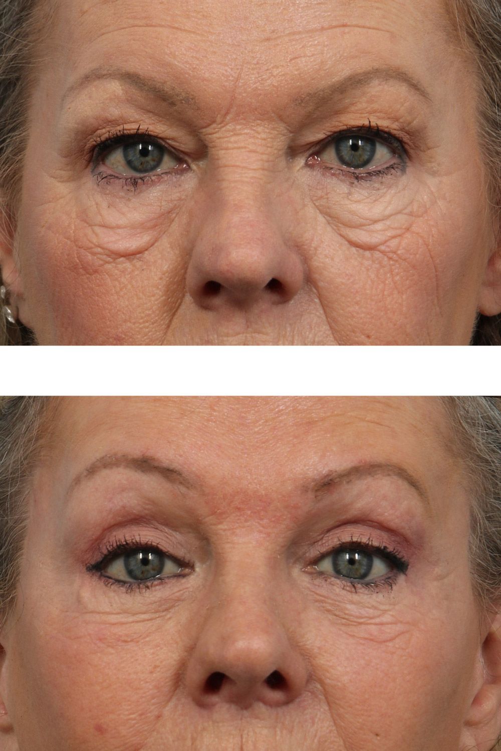 Eye Lift Image 06