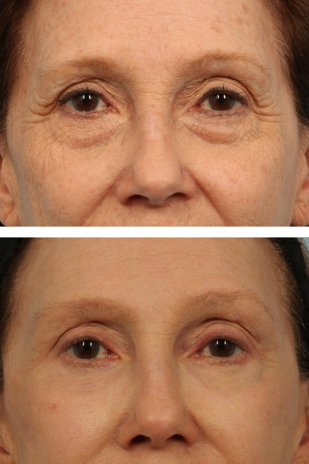 Eye Lift Image 03