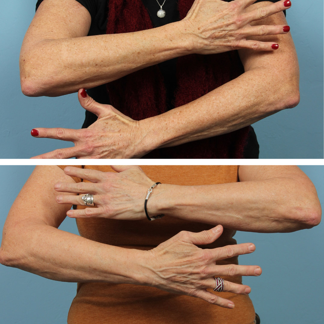 BBL laser treatments for arm pigmentation on a 50-year-old woman