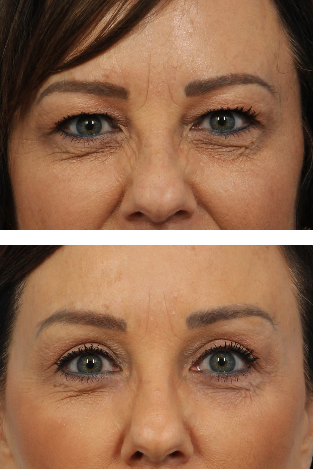 Blepharoplasty (eyelid surgery) on a 50-year-old woman