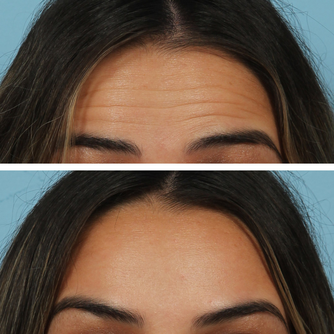 Botox on forehead to treat horizontal lines on a 40-year-old woman