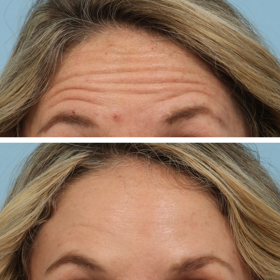 Botox on forehead to treat horizontal lines on a 40-year-old woman
