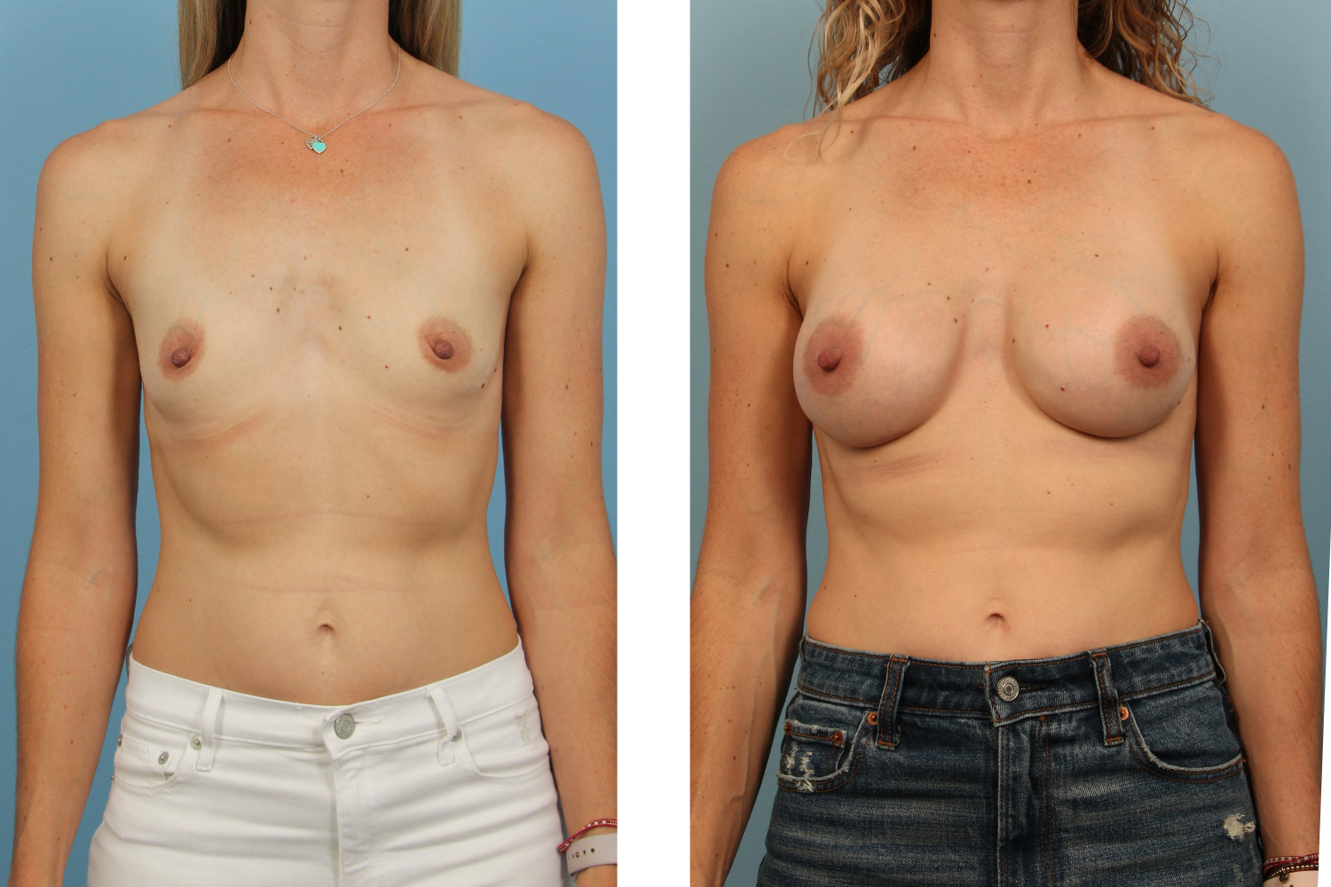 Breast augmentation on a 40-year-old woman