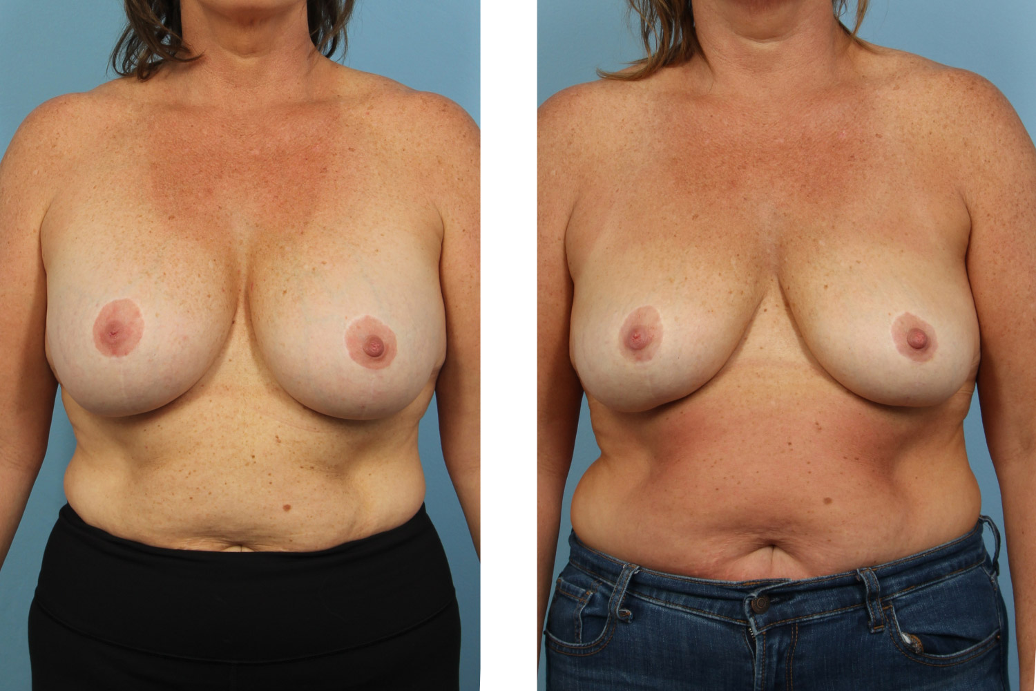 Breast implant removal and capsulectomy on a 45-year-old woman