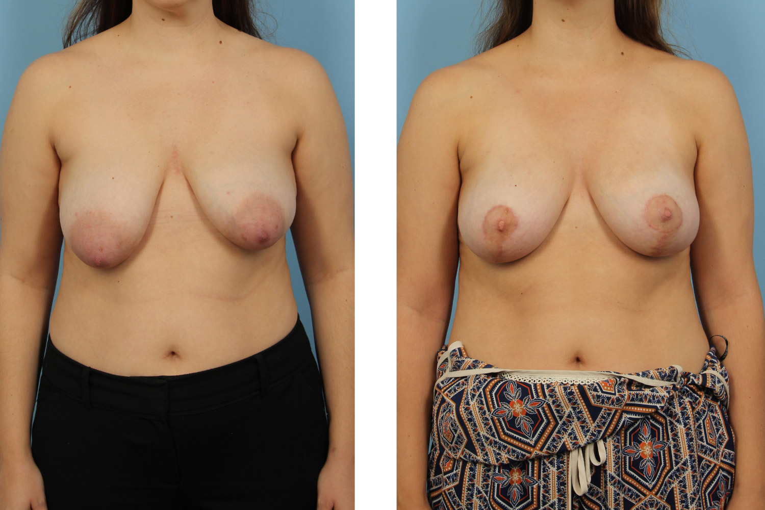 Breast lift with adjacent liposuction and fat transfer with breast reduction on a 30-year-old woman