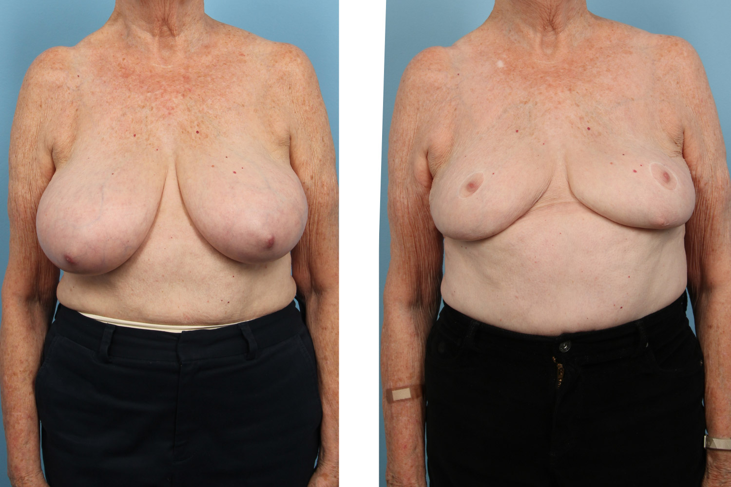 Breast reduction on a 75-year-old woman