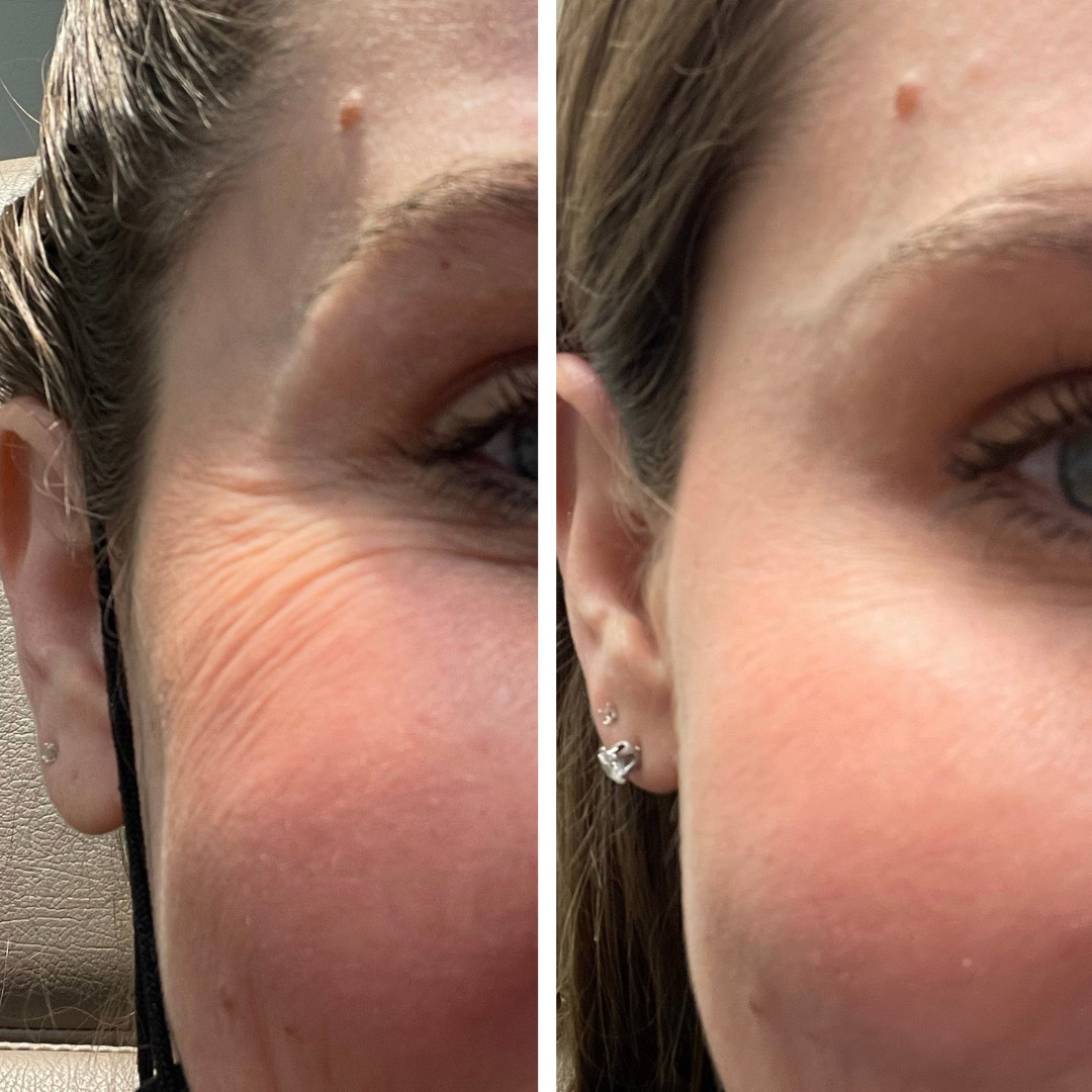 Dysport on forehead to treat crow's feet lines on a 40-year-old woman