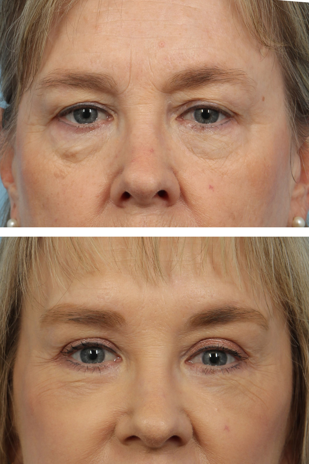 Lower and upper blepharoplasty (eyelid surgery) 60-year-old woman with light skin