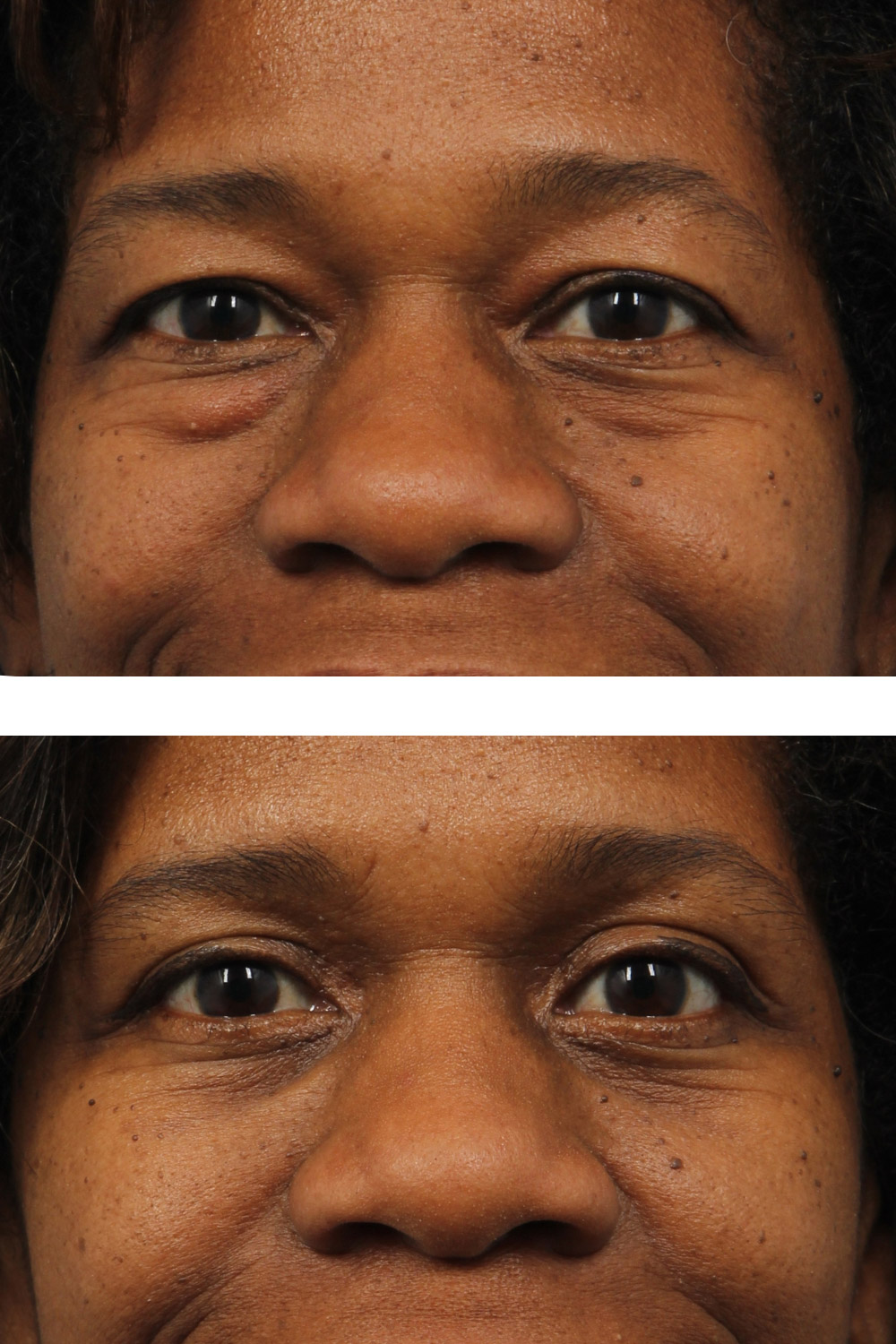 Lower and upper blepharoplasty (eyelid surgery) 50-year-old woman with dark skin