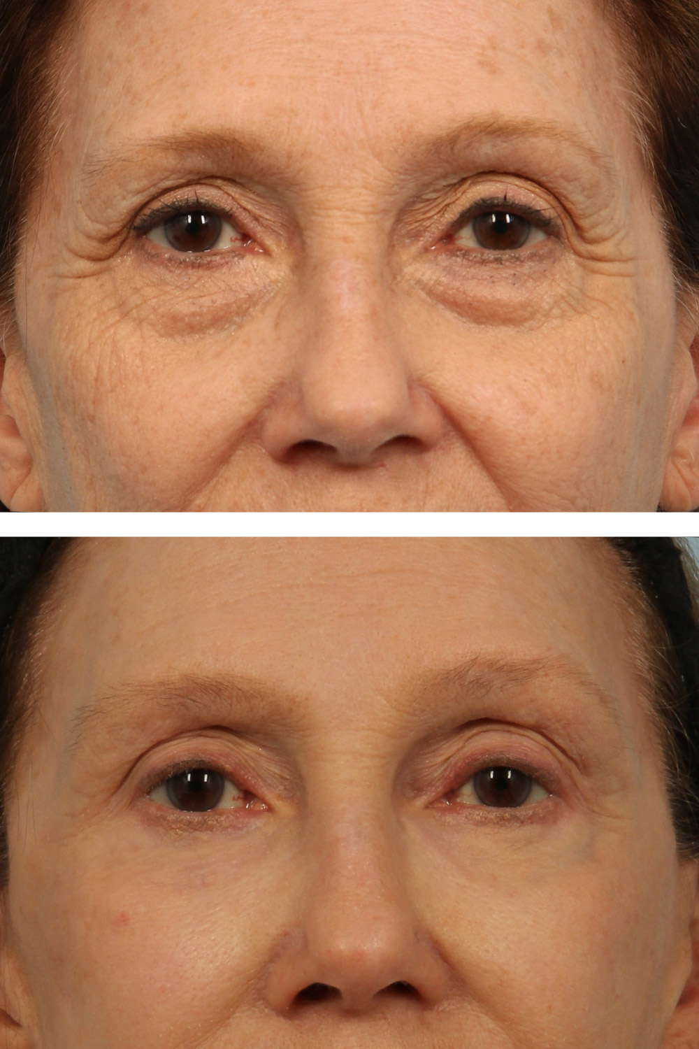 Lower and upper blepharoplasty (eyelid surgery) and laser resurfacing on a 60-year-old woman