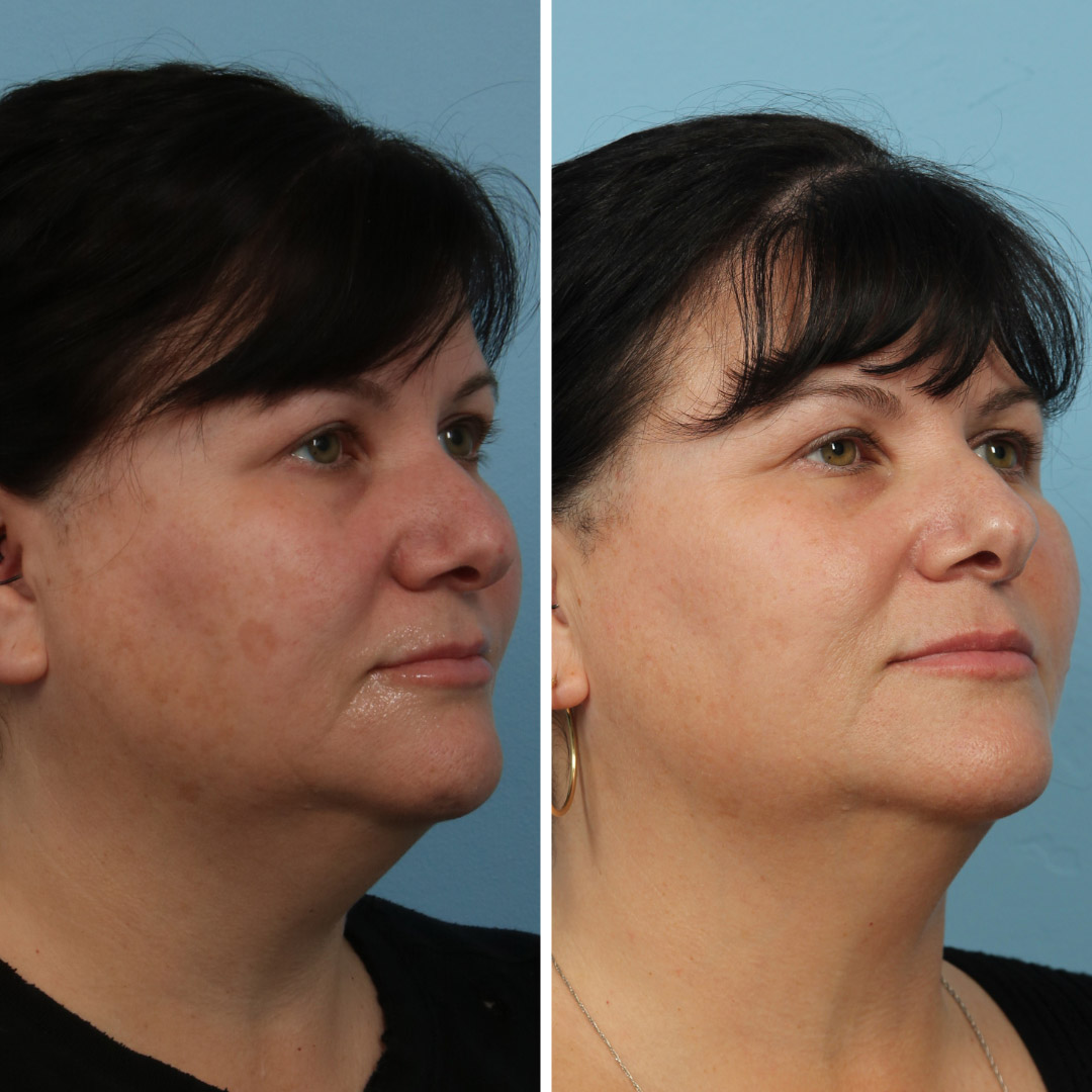 Halo laser treatment on the face of a 40-year-old woman for reducing wrinkles and fixing uneven pigmentation