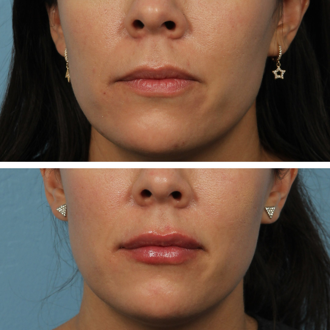 Restylane dermal filler lip injections on a 30-year-old woman