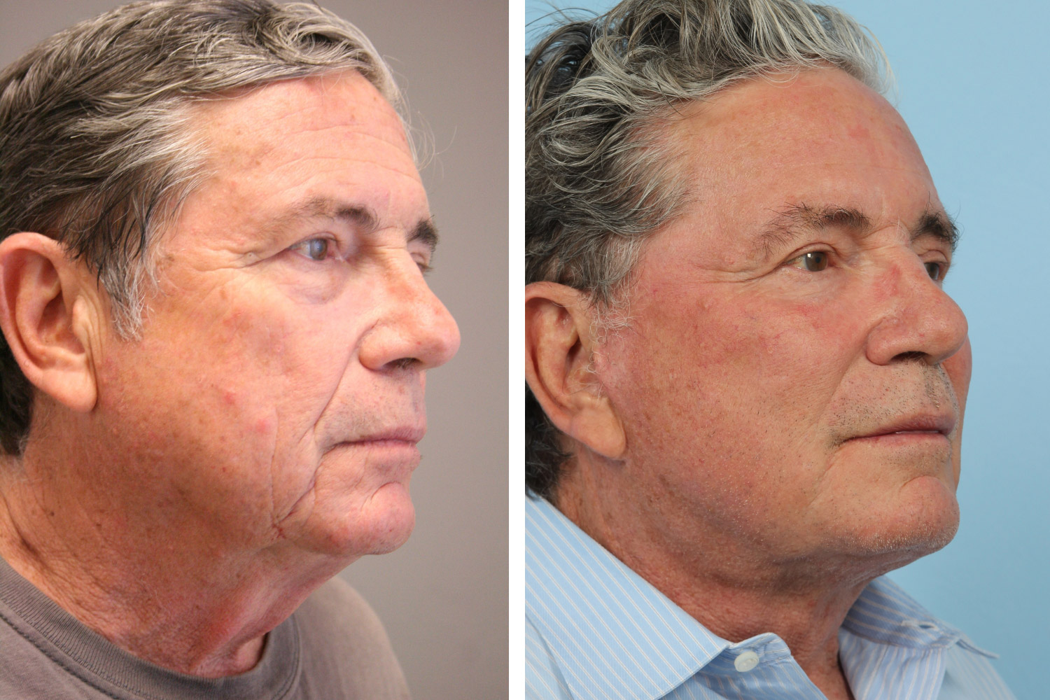 Lower face lift and neck lift with fat injections lower blepharoplasty, and laser resurfacing on a 60-year-old man